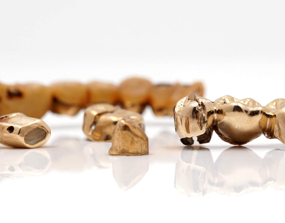 zahngold ankauf prozess wert